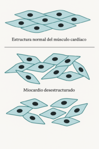 Miocardiopatía hipertrófica