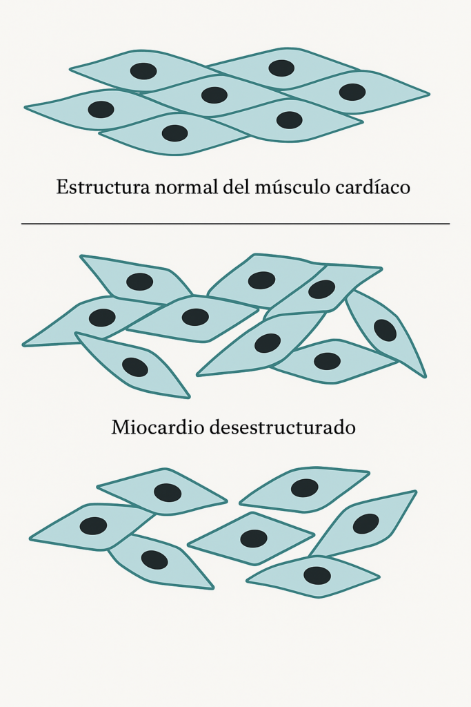 Miocardiopatía hipertrófica